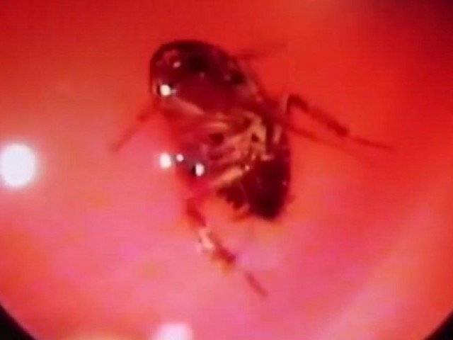 Watch: Doctor pulls live cockroach from woman's skull