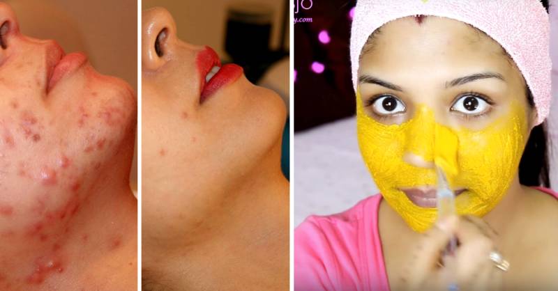 Cure Acne with DIY magical face packs
