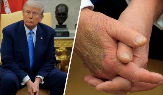President Trump diagnosed with vein issues after leg swelling observed: White House 